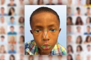 محققان با استفاده از تکنولوژی تشخیص چهره، بیماری‌ نادر ژنتیکی را شناسایی می‌کنند
