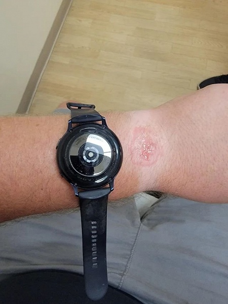 Dangerous technologies the user was burned by smart watches Samsung قطب آی تی